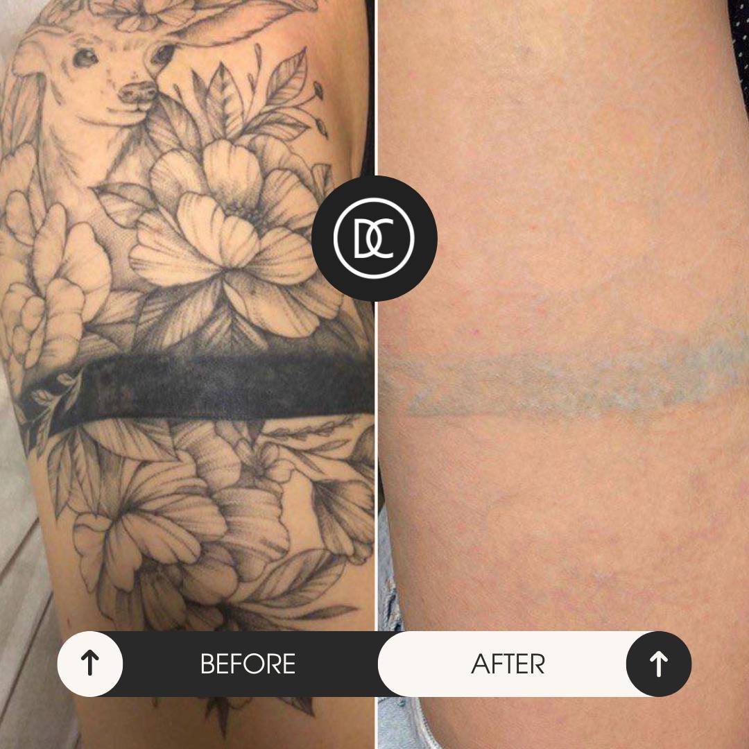 Після видалення тату